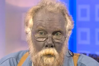 paul-karason-the-man-who-turned-blue-from-colloidal-silver