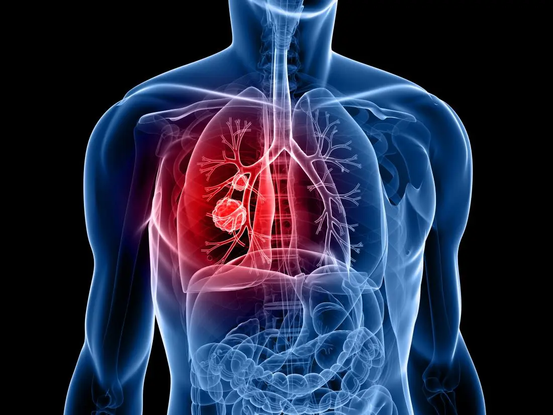 lung-cancer-pills-reduce-risk-of-death-by-half-study